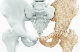 Osteoporose e exercício físico